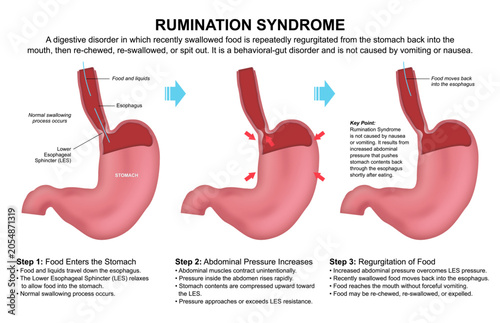 Fotografie Rumination syndrome, Stomach Flashcard Illustration