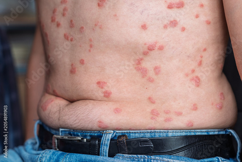 Bild auf Leinwand Close-up view of a male torso displaying psoriasis lesions on the skin, wearing