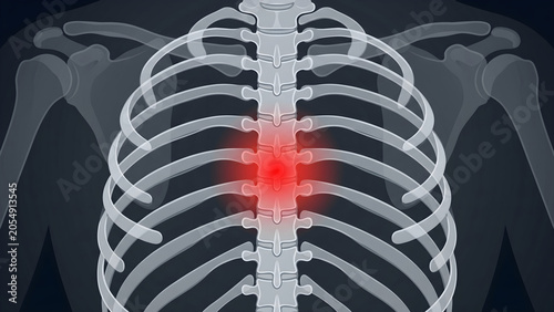 Thoracic spine chest pain x-ray illustration showing mid back inflammation