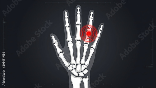 Hand fingers joint pain x-ray illustration showing arthritis symptoms