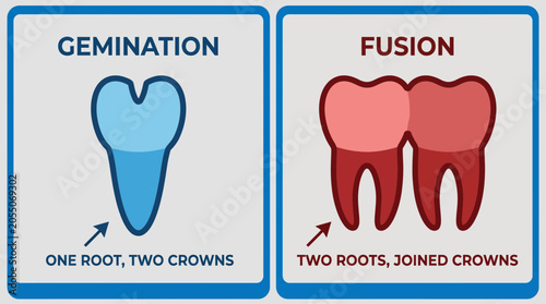 Foto Gemination Fusion Dental Anomaly Comparison