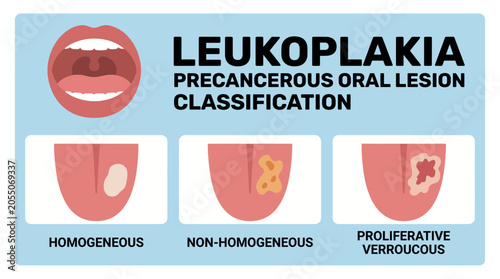 Foto Leukoplakia Precancerous Oral Lesion Classification