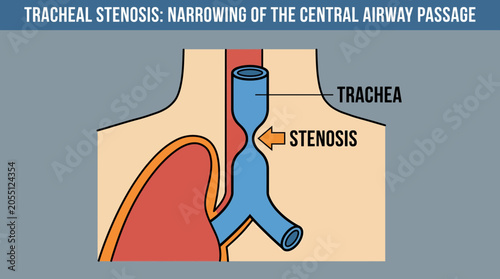 Photos Tracheal Stenosis Narrowing of the Central Airway Passage