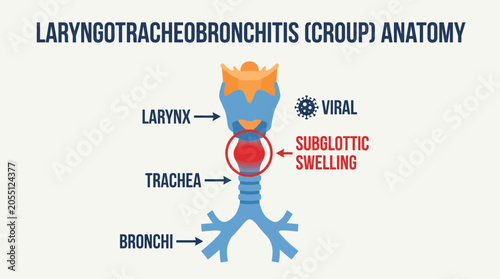 Quadro em tela Laryngotracheobronchitis Croup Viral Subglottic Swelling Anatomy