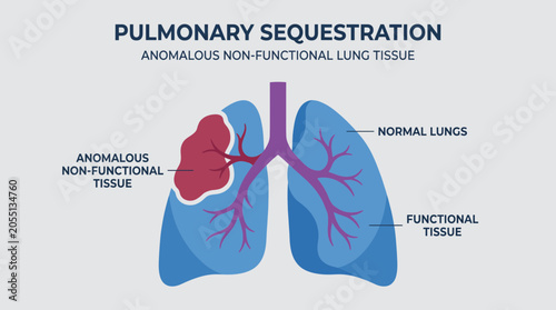 Photography Pulmonary Sequestration Anomalous Non-Functional Lung Tissue