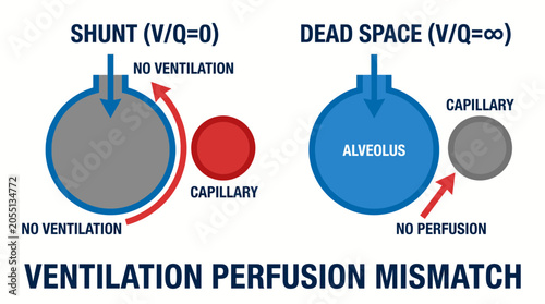 Schilderij op canvas Ventilation Perfusion Mismatch Shunt and Dead Space Diagram