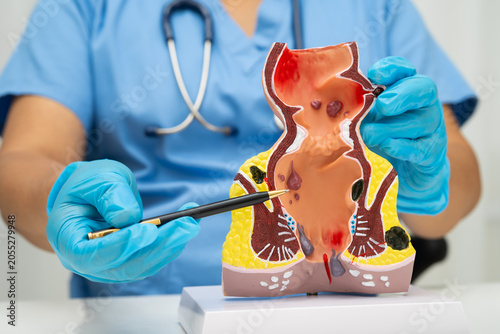Εκτύπωση καμβά Asian doctor with rectum and hemorrhoid human anatomy model at hospital, inflamed vascular structure