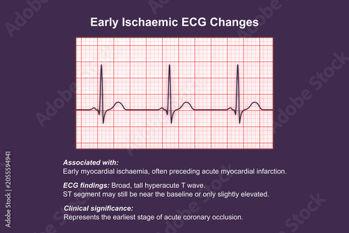 Fotografía Electrocardiogram showing hyperacute T waves, 3D illustration of ECG trace indicating early acute myocardial ischemia with tall symmetrical T waves
