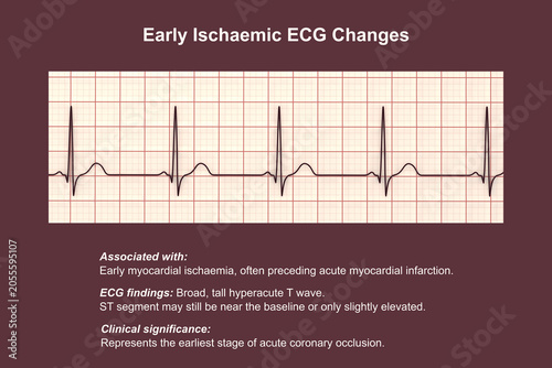 Photos Electrocardiogram showing hyperacute T waves, 3D illustration of ECG trace indicating early acute myocardial ischemia with tall symmetrical T waves