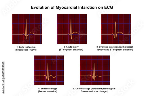 фотографія Evolution of myocardial infarction on ECG, 3D illustration showing stages from hyperacute T wave to chronic pathological Q wave changes