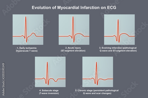 Canvastavla Evolution of myocardial infarction on ECG, 3D illustration showing stages from hyperacute T wave to chronic pathological Q wave changes