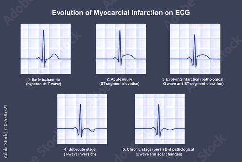 Konstfotografi Evolution of myocardial infarction on ECG, 3D illustration showing stages from hyperacute T wave to chronic pathological Q wave changes