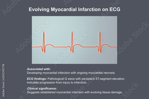 Foto Electrocardiogram showing pathological Q wave with ST-segment elevation, 3D illustration of ECG trace indicating acute myocardial infarction