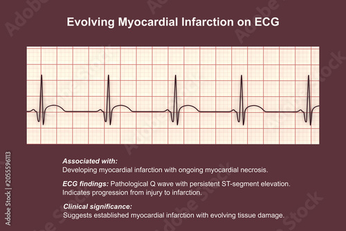 Konstfotografi Electrocardiogram showing pathological Q wave with ST-segment elevation, 3D illustration of ECG trace indicating acute myocardial infarction