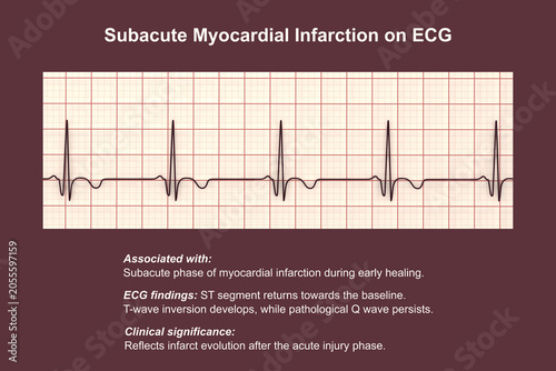 Foto Subacute stage of myocardial infarction, 3D