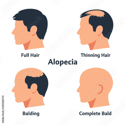 Male hair loss progression stages, illustrating the journey from full hair to thinning, balding, and complete baldness in men