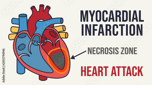 Obraz na płótnie Myocardial Infarction Heart Attack Zone Necrosis Illustration