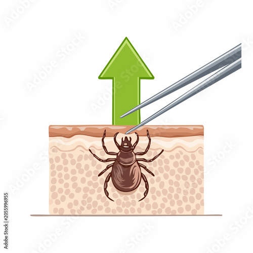 Tick Removal with Tweezers and Upward Arrow