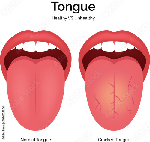 Healthy vs. Cracked Tongue Comparison Illustration