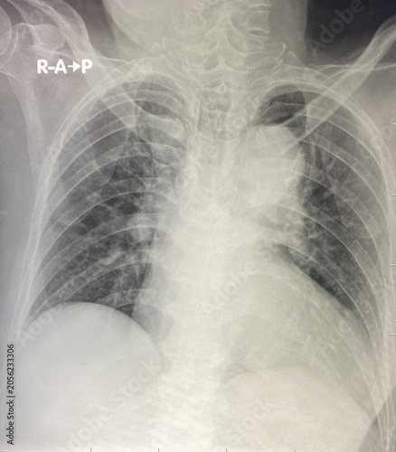 Chest X-Ray Radiograph Image – Human Thoracic Anatomy and Lung Examination