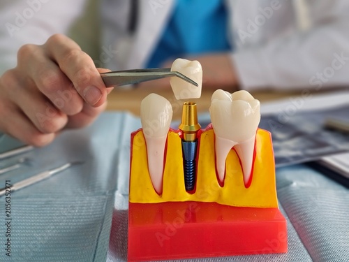 Fotografia Demonstration of dental implant placement using a model in a dental