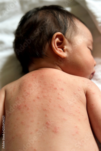 Sick baby sleeping with measles rash on back. Infantile skin disease and viral infection symptom. Medical diagnosis and pediatric immunology concept of childhood illness symptoms.