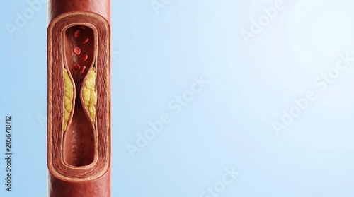 Atherosclerosis Artery Narrowing with Cholesterol Plaque Accumulation