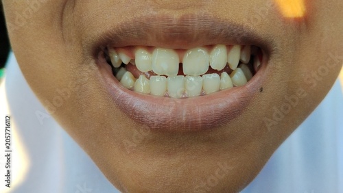 Photos Front view macro closeup of human teeth with middle incisor gap
