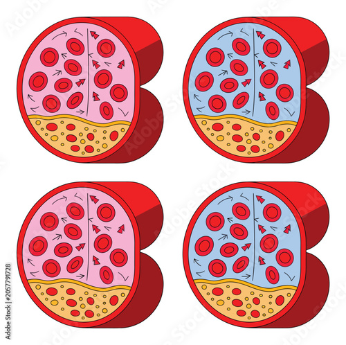 Εκτύπωση καμβά Medical showing cross-sections of vessels with plaque buildup and red cell flow