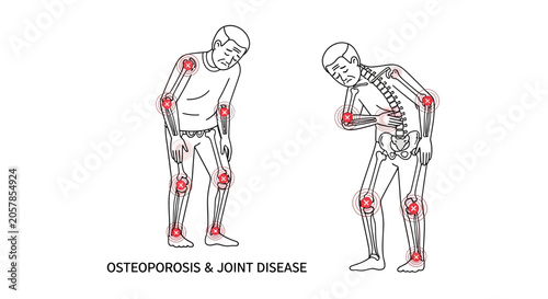 Illustration of osteoporosis and joint disease affecting elderly people.