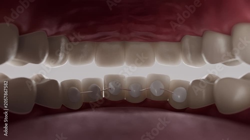 3D animation of lingual braces gradually aligning teeth from the inner side. Modern orthodontic treatment and invisible dental correction concept