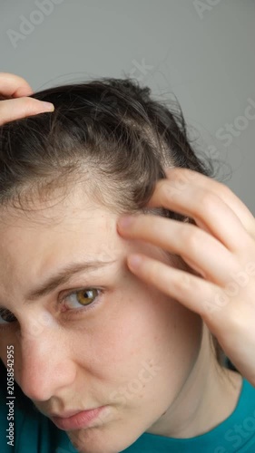 Woman showing receding hairline and thinning hair.