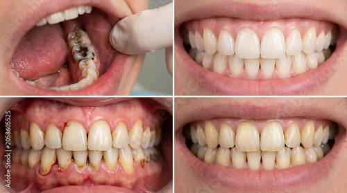 Four dental condition comparisons showing decay gum disease and healthy teeth mouth cavity
