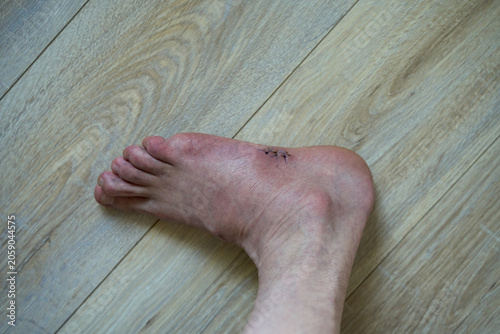 Surgical stitches on a human foot after medical treatment. High-angle close-up of surgical sutures on the side of a human foot over a wooden floor background.