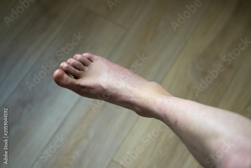 Bruised and swollen human foot after a traumatic injury. High-angle view of a swollen human foot with a blue bruise and hematoma on the skin over a wooden floor background.