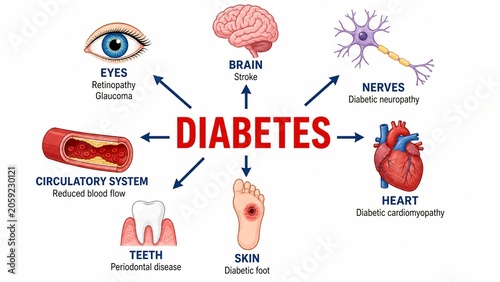 Diabetes Complications Infographic Illustrating the Systemic Impact of High Blood Sugar on the Eyes Brain Heart and Other Organs