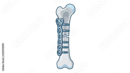 Konstfotografi Surgical orthopedic plate and screws on a fractured human bone