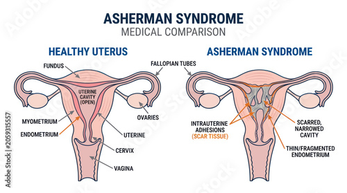 Foto Medical comparison of healthy uterus and asherman syndrome