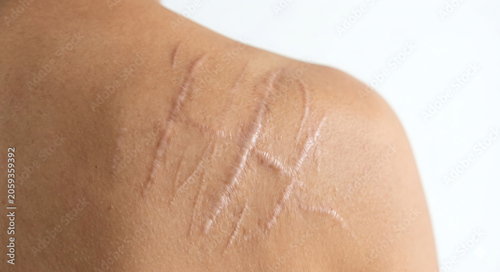 Fototapeta premium Person with visible whipping scars on their back and shoulder