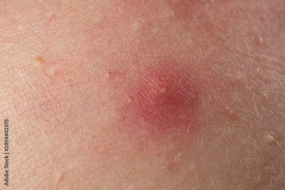 Fototapeta premium Skin problem background with infected bumps and acne. Inflamed skin bumps acne macro. Close up acne on skin. Irritated acne skin.