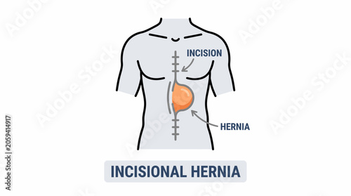 Slika na platnu Medical illustration of an incisional hernia, showing a bulge occurring at the site of a previous surgical incision on the human abdomen