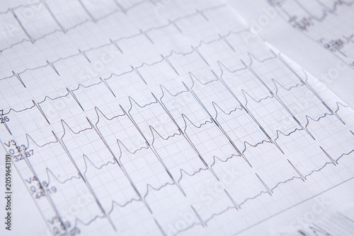 Electrocardiogram (ECG) on a white background
