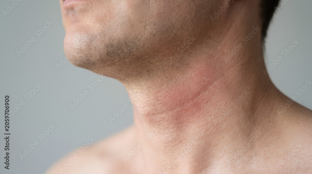 Naklejka premium Closeup of a mans neck with a red, irritated skin rash or allergic reaction