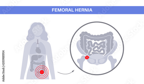 Abdominal Hernia poster