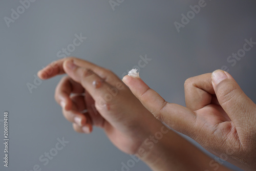Schilderij op canvas Close up of medicated ointment on fingertip for minor burn treatment