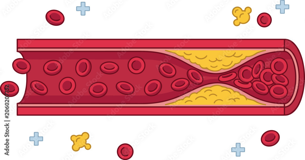 Ταπετσαρία Atherosclerosis Medical Illustration showing Artery Blood Vessel Cross Section B