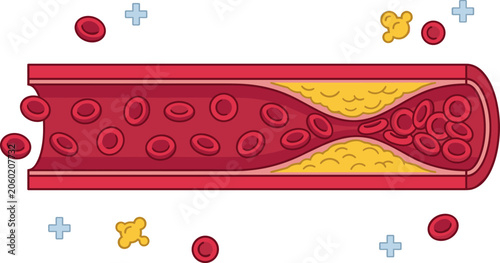 Atherosclerosis Medical Illustration showing Artery Blood Vessel Cross Section Blocked by Cholesterol Plaque Buildup Constricting Red Blood Cell Flow Graphic