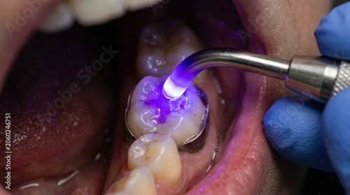 Dentist using a blue light curing lamp to harden a dental filling