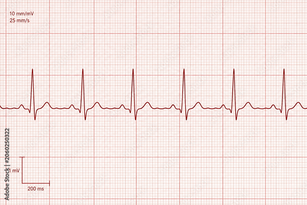 Fototapeta premium An electrocardiogram (ECG) tracing displays a patient's heart electrical activity over time.