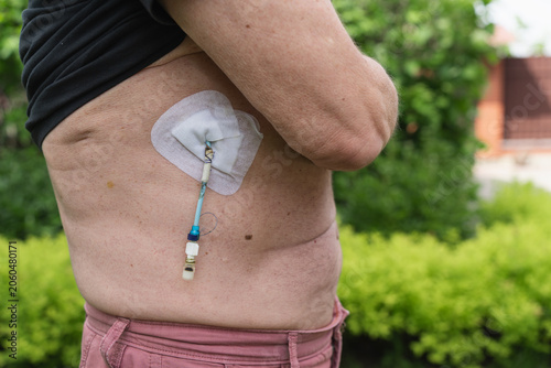 Vertical close-up of an adult abdomen with a secured medical drainage catheter while the patient lifts a black shirt, postoperative wound care and recovery concept.